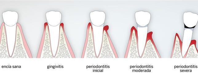 Gingivitis | ODOS Dental