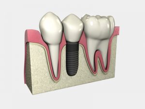 Implante Dental | ODOS Dental