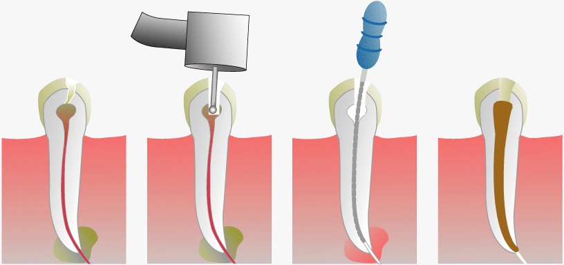 Cómo se hace una endodoncia | ODOS Dental