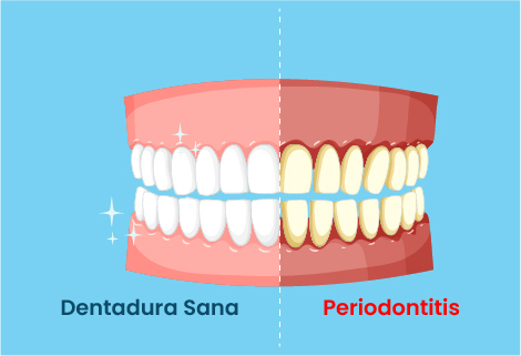 Periodontitis: qué es | ODOS Dental