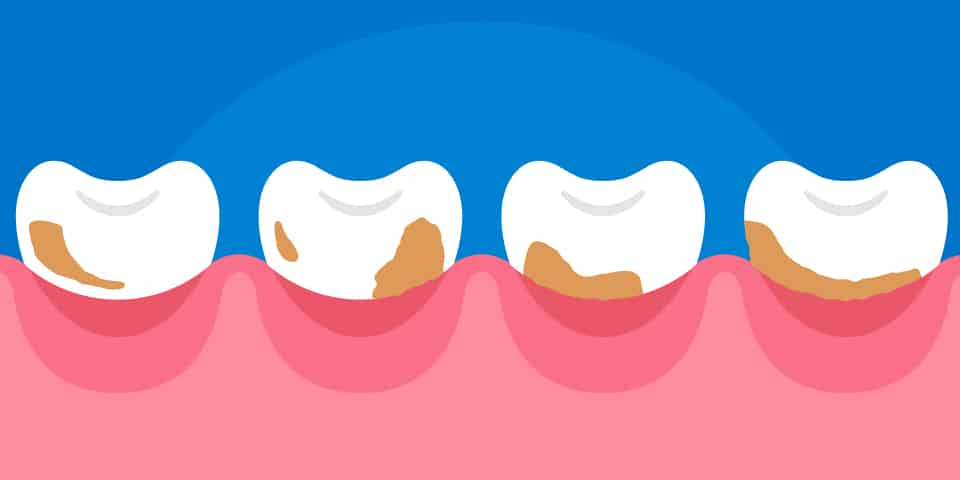 Placa bacteriana y gingivitis | ODOS Dental