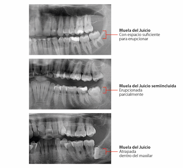 Posiciones muela del juicio | ODOS Dental