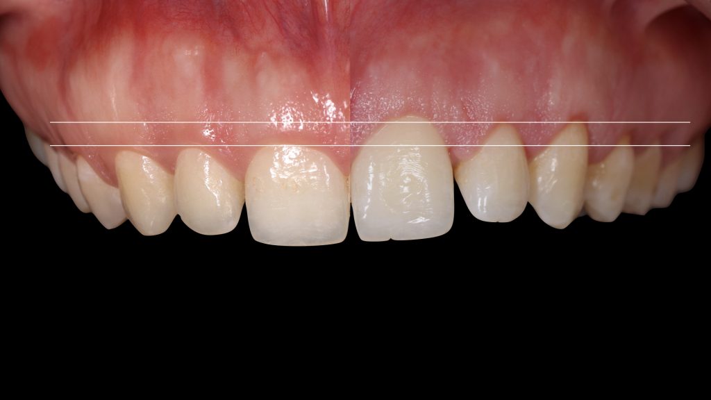 Gingivectomía | ODOS Dental