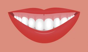 Sonrisa gingival | ODOS Dental