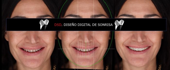 Antes y después de diseño de sonrisa digital | ODOS Dental
