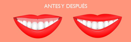 Sonrisa gingival: antes y después | ODOS Dental